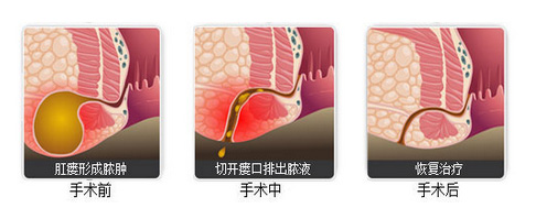 肛瘘治療前後對(duì)比