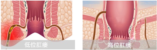高(gāo)低(dī)位肛瘘病理(lǐ)圖
