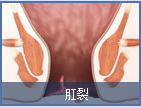 肛裂