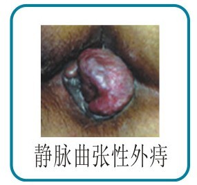 靜(jìng)脈曲張性外(wài)痔