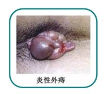 炎性外(wài)痔