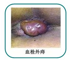 血栓性外(wài)痔