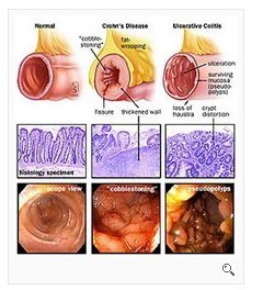 結腸炎分(fēn)期