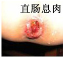 直腸息肉