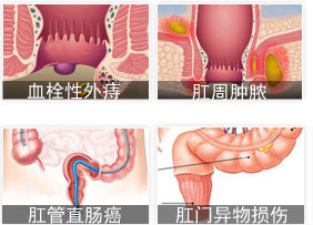 肛門(mén)內(nèi)部疼的(de)病因