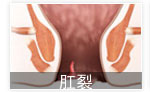 肛裂