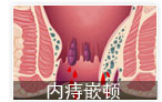 內(nèi)痔嵌頓