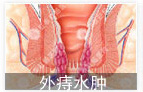 外(wài)痔水(shuǐ)腫