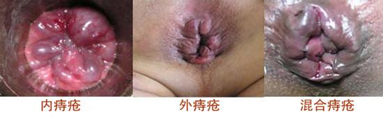 內(nèi)痔外(wài)痔混合痔
