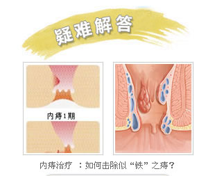 內(nèi)痔分(fēn)期