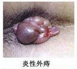 炎性外(wài)痔