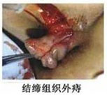 結締組織型外(wài)痔