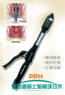 PPH微(wēi)創術(shù)