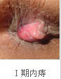 一(yī)期內(nèi)痔