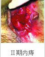 二期內(nèi)痔