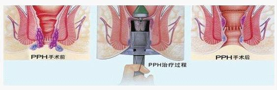 pph微(wēi)創術(shù)