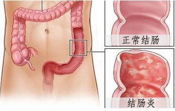 結腸炎