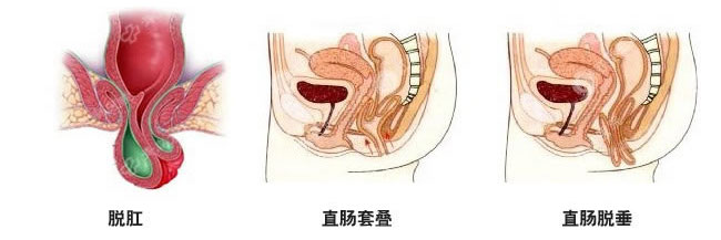 脫肛手術(shù)費(fèi)用(yòng)