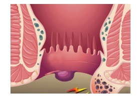 血栓性外(wài)痔