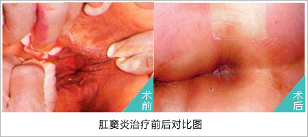肛窦炎治療前後對(duì)比圖