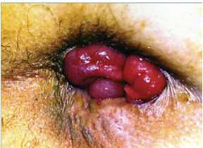 Ⅰ度：粘膜脫垂型